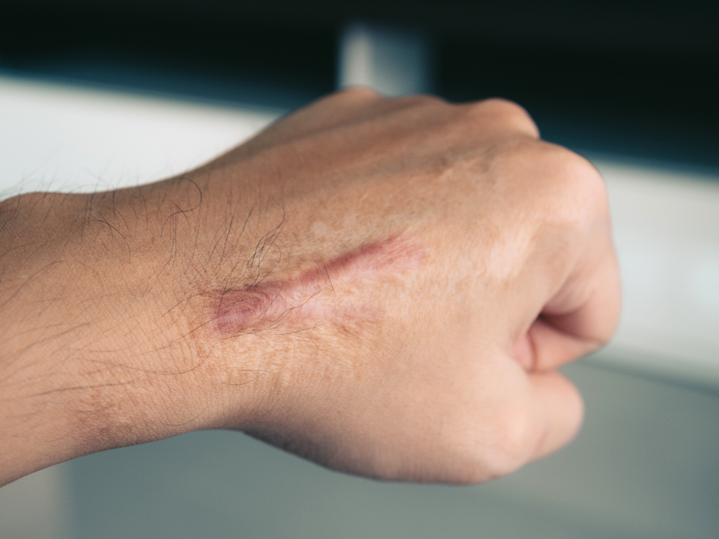 Prevent lacerations like the one that made a big scar on this man's hand